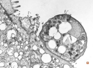 M,33y. | microsporidiosis (or cryptosporidiosis) - duodenum-posttransplantation immunodeficiency